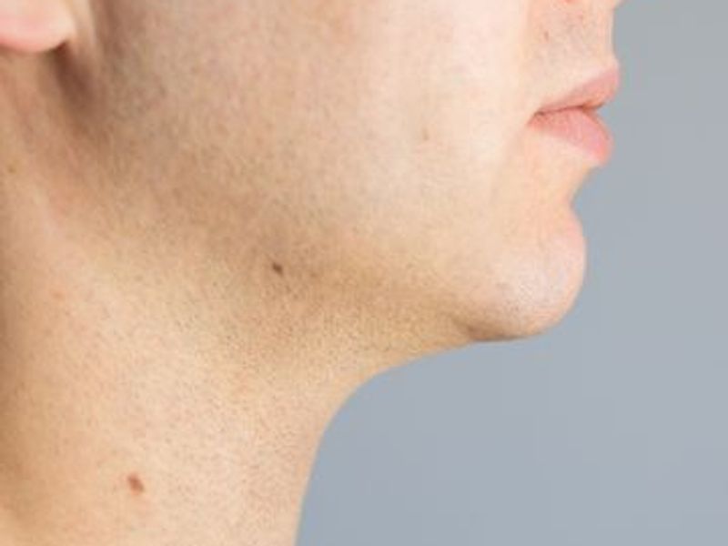 Fat-dissolving injection Fat-dissolving injection before and after pictures for double chin in Montreal