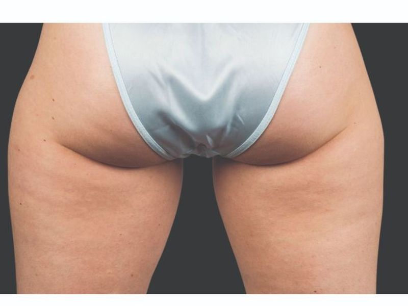 Glutes and thighs After CoolSculpting Body Contouring fat loss Treatment in Montreal