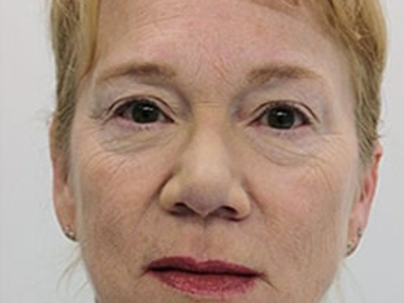 Patient after rejuvenate Scarlet-S RF treatment - Ideal Body Clinic Montreal