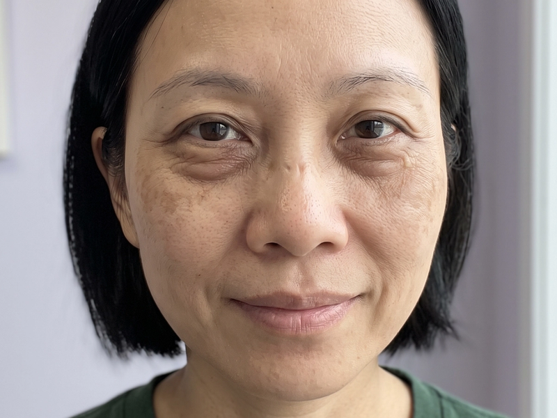 Patient photographed before treatment, facing the camera under even, directional daylight.