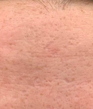 Before Secret Pro by Cutera for forehead skin - Montreal