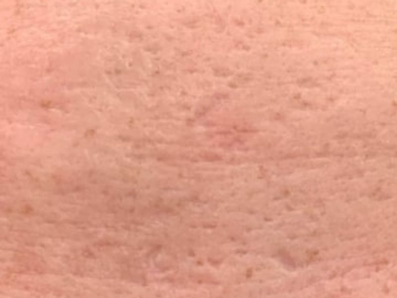 Before Secret Pro by Cutera for forehead skin - Montreal