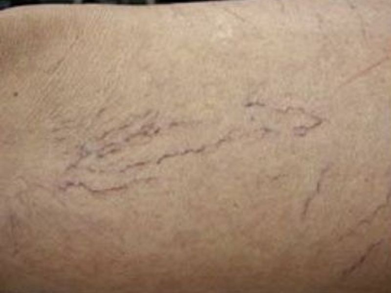 Before Fotona Laser Skin treatment spider veins - Montreal