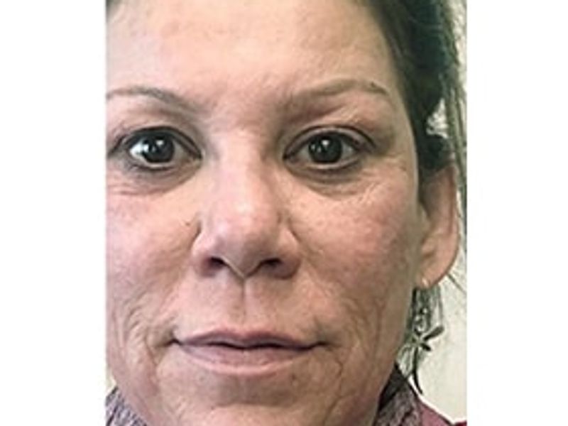 Patient before Scarlet-S RF treatment for wrinkles - Ideal Body Clinic Montreal