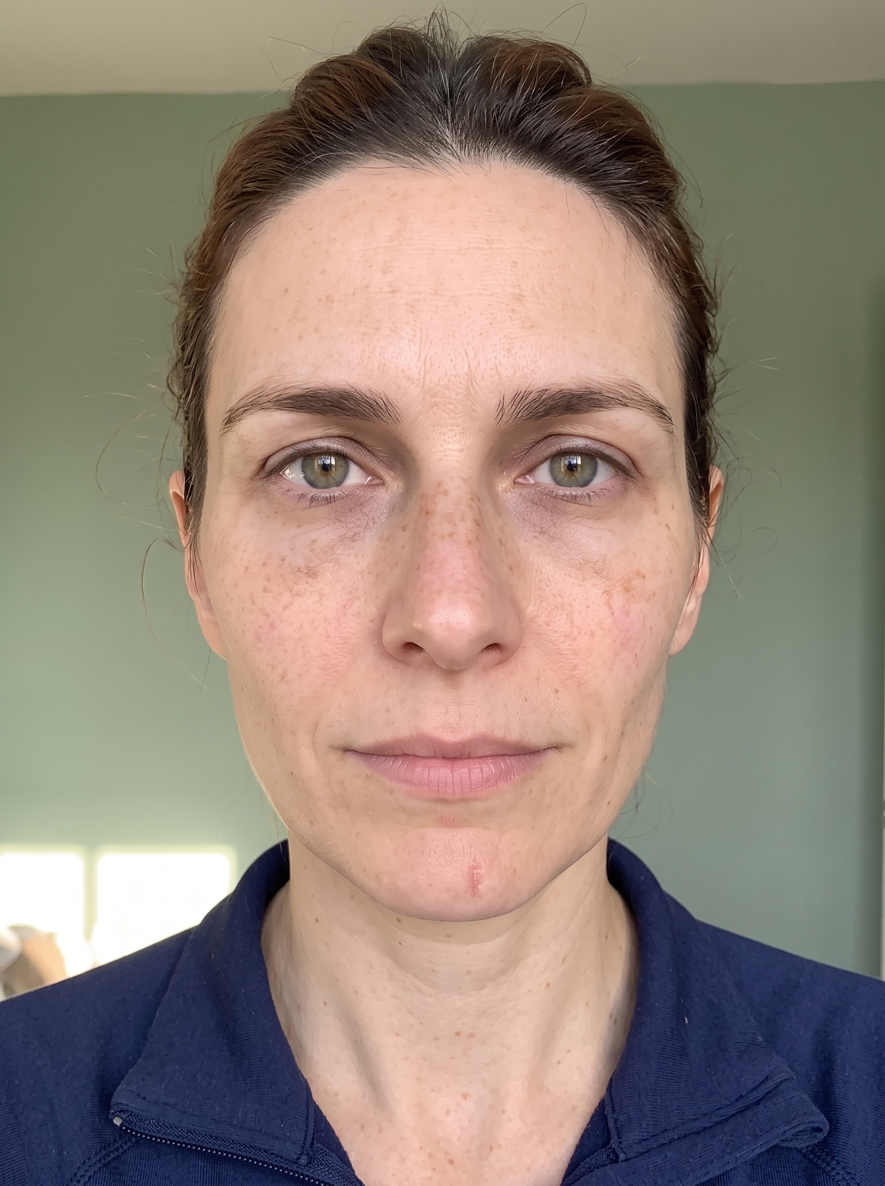 The same patient photographed at a later visit, from the same angle and under the same lighting.