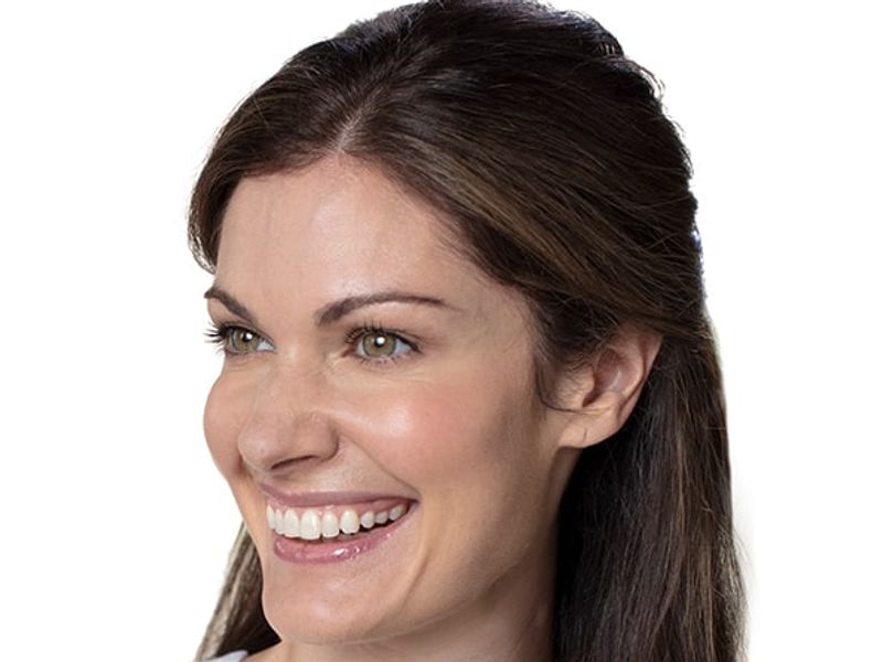 After Aesthetic Wrinkle relaxer Treatments for crows feet in Montreal