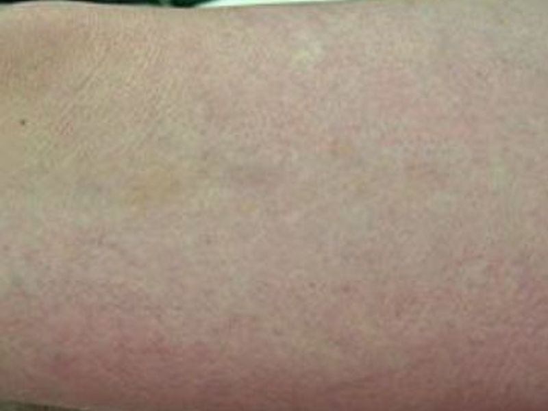 Before Fotona Laser Skin treatment spider veins - Montreal
