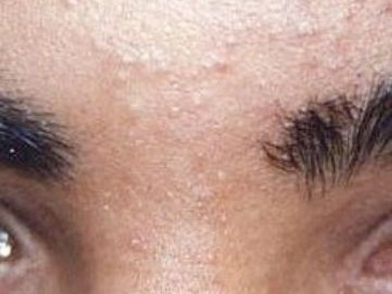 After Fotona Laser Skin Treatment for facial hair removal - Montreal
