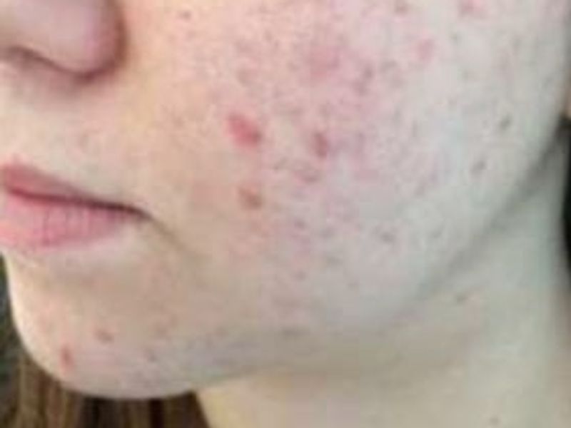 Patient before Scarlet-S RF treatment for acne and acne scars - Ideal Body Clinic Montreal