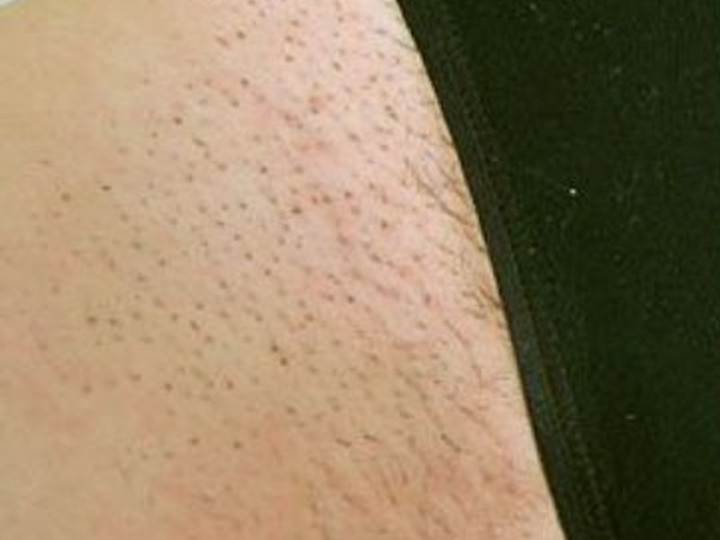 Before Fotona Laser Skin Treatment for bikini hair removal - Montreal