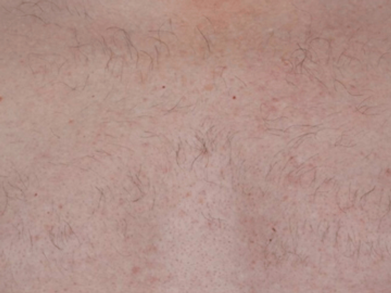 Chest laser hair removal after Excel HR treatment in Montreal