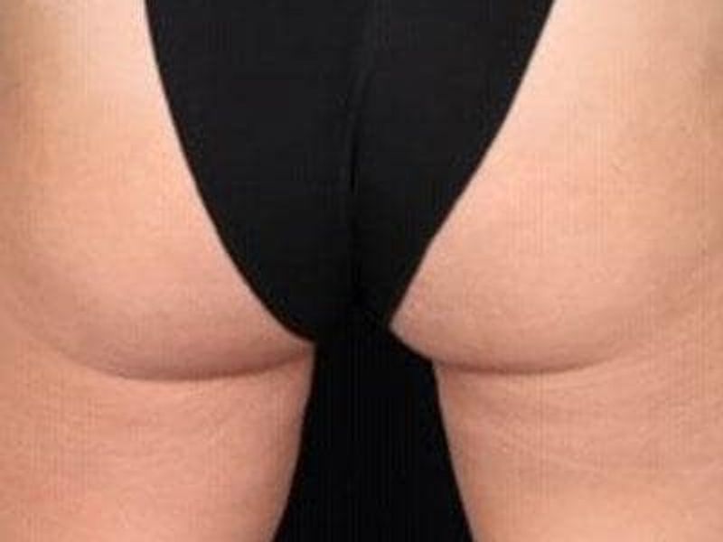After Profound Radiofrequency Microneedling glutes and thighs treatment - Montreal