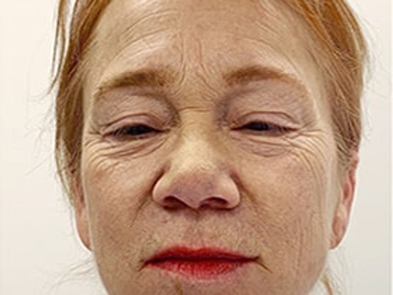 Patient before rejuvenate Scarlet-S RF treatment - Ideal Body Clinic Montreal