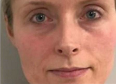 The same face after exosomes following microneedling, with visibly less redness.