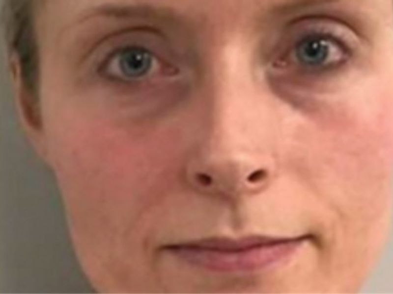 The same face after exosomes following microneedling, with visibly less redness.