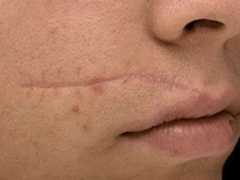 Before Fotona Laser Skin Treatment for scar removal - Montreal