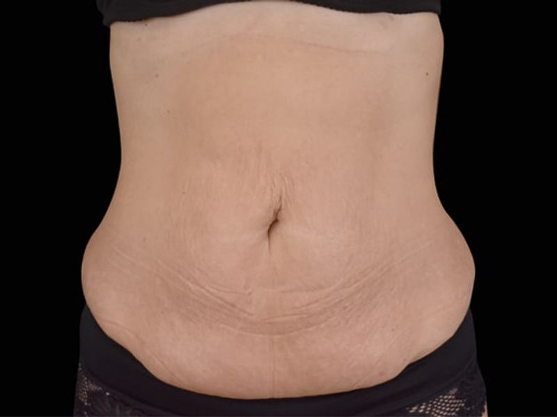 Sagging belly fat AfterEmsculpt NEO Body Contouring fat removal therapy in Montreal