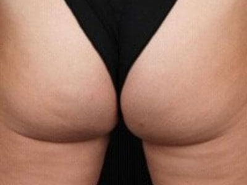 Before Profound Radiofrequency Microneedling glutes and thighs treatment - Montreal