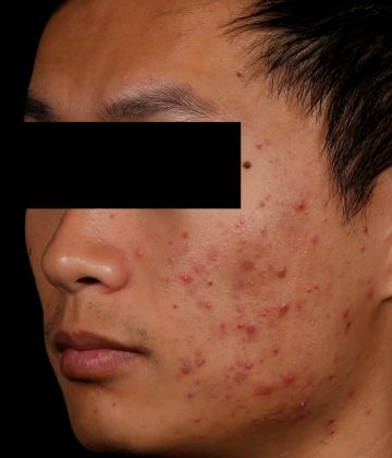 Before AviClear laser acne removal treatment in Montreal