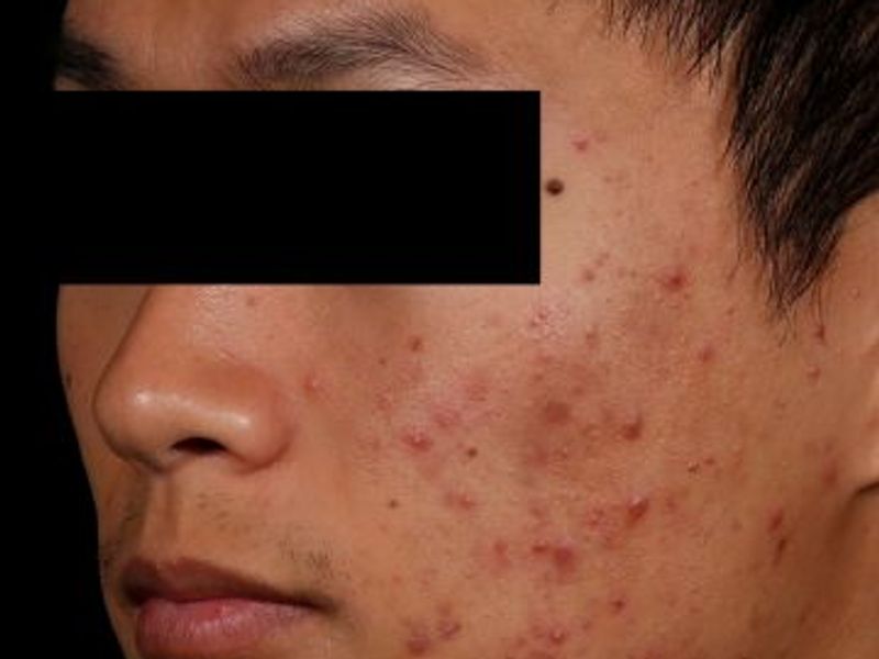 Before AviClear laser acne removal treatment in Montreal