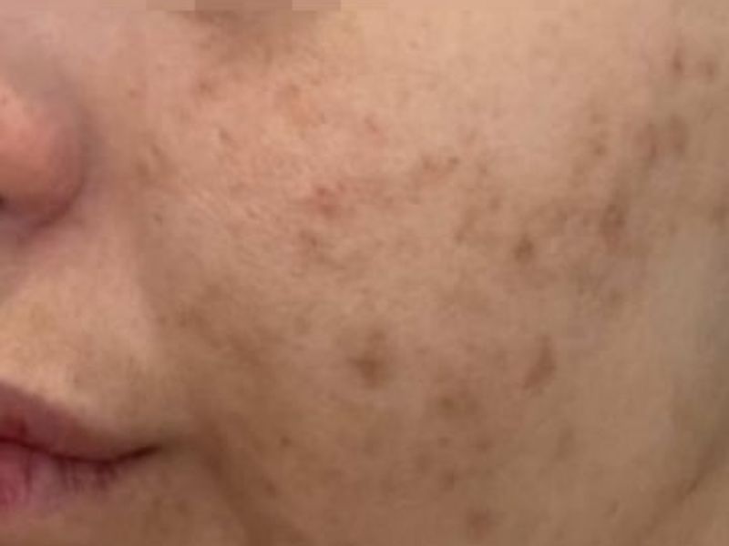 Before Secret Pro by Cutera for acne and acne scars - Montreal
