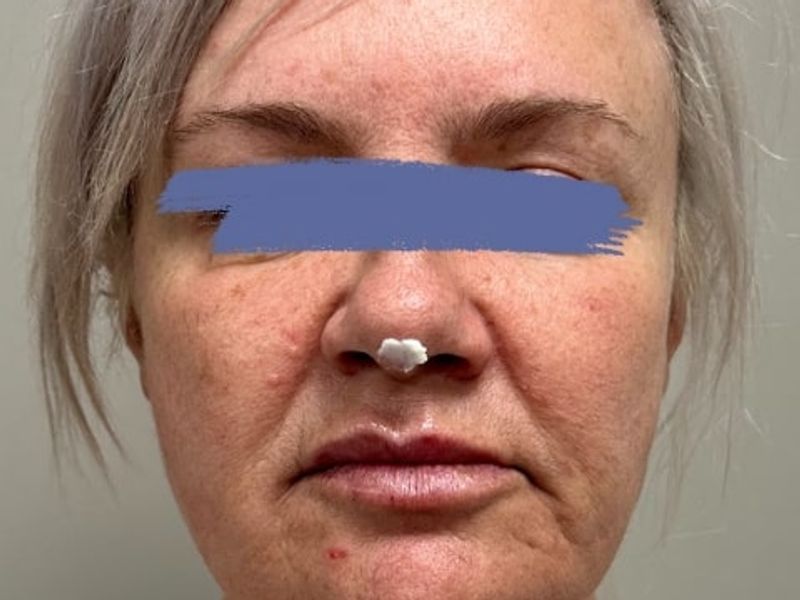 After Female PDO thread nose lift procedure at our Montreal aesthetic clinic