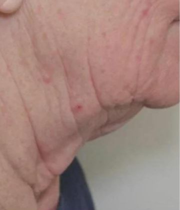 Before Submental and neck Sofwave Treatment Picture in Montreal