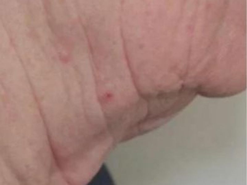 Before Submental and neck Sofwave Treatment Picture in Montreal