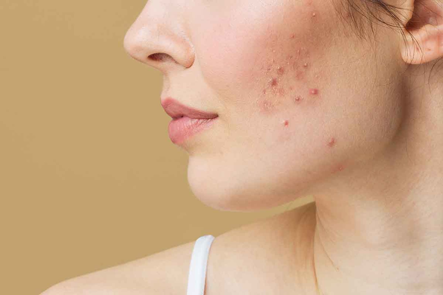 🌟 Clear Skin Solutions: Advanced Acne Protocols at Ideal Body Clinic