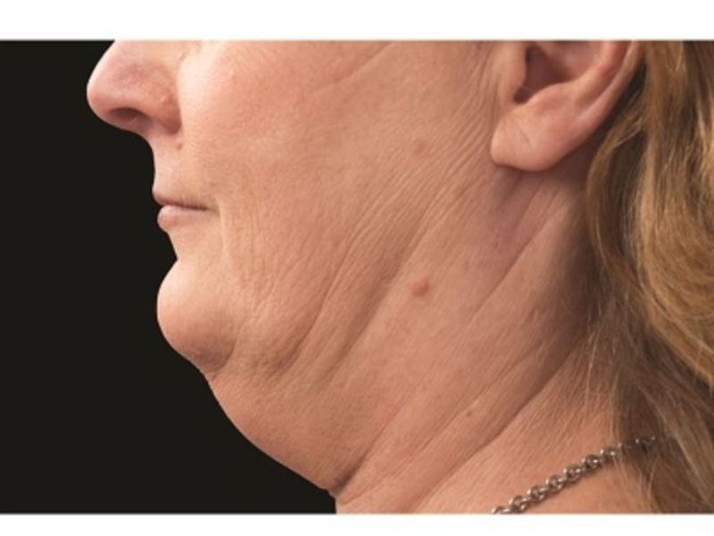 Sagging Double chin Before CoolSculpting Body Contouring fat loss Treatment in Montreal