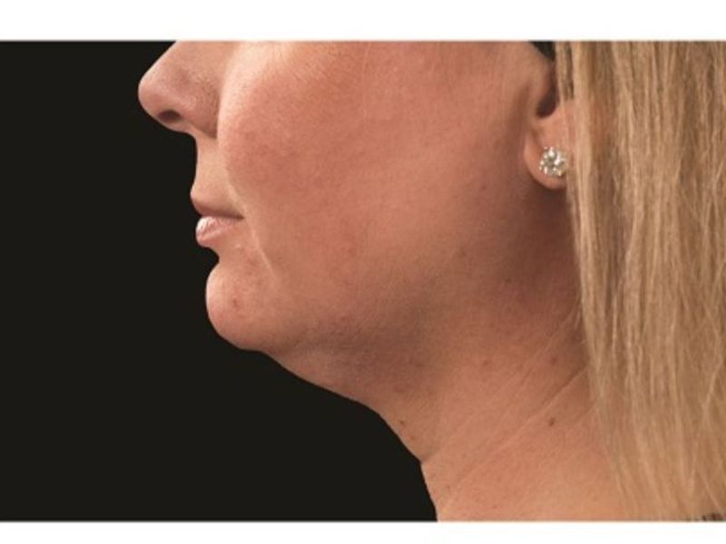 Sagging Double chin Before CoolSculpting Body Contouring fat loss Treatment in Montreal