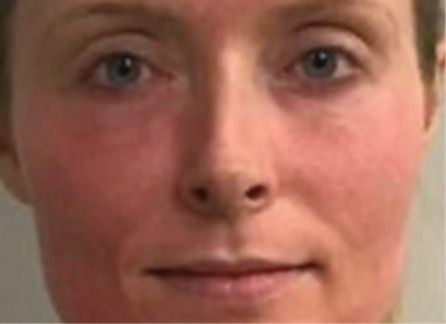 Front view of a patient's face with diffuse redness on the cheeks before treatment.