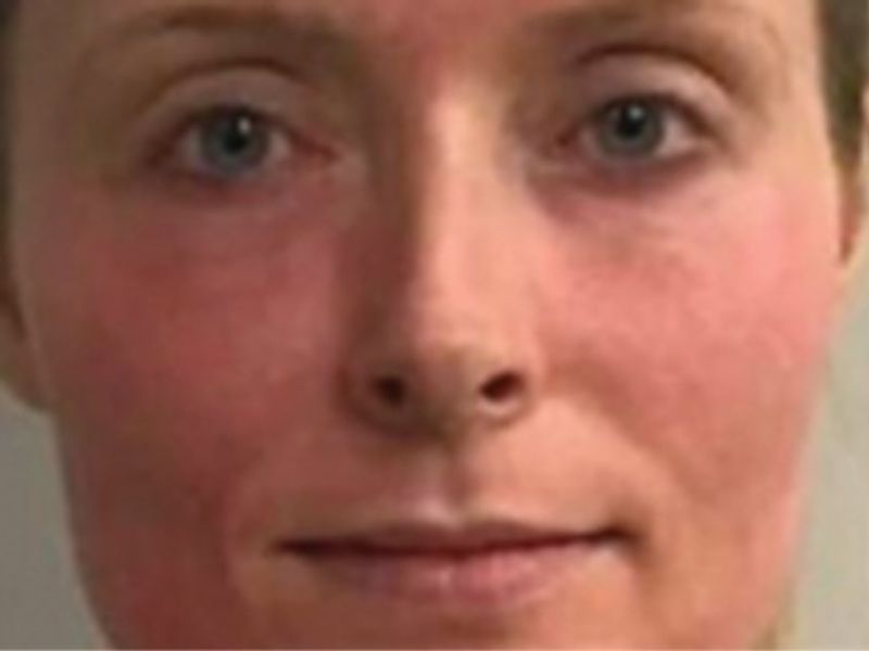 Front view of a patient's face with diffuse redness on the cheeks before treatment.