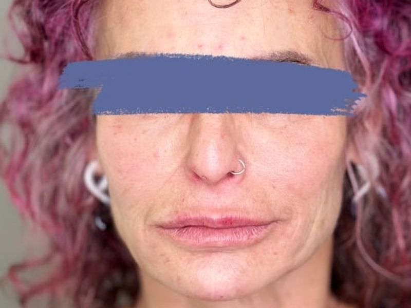 After Female Lip Fillers procedure at our Montreal aesthetic clinic