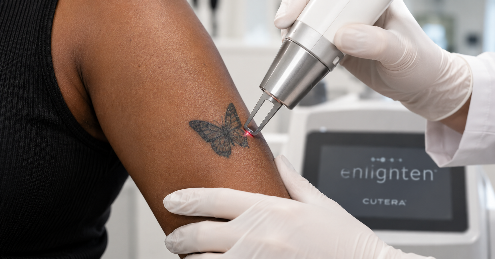Close-up of a laser handpiece positioned over a black tattoo on a person with darker skin.