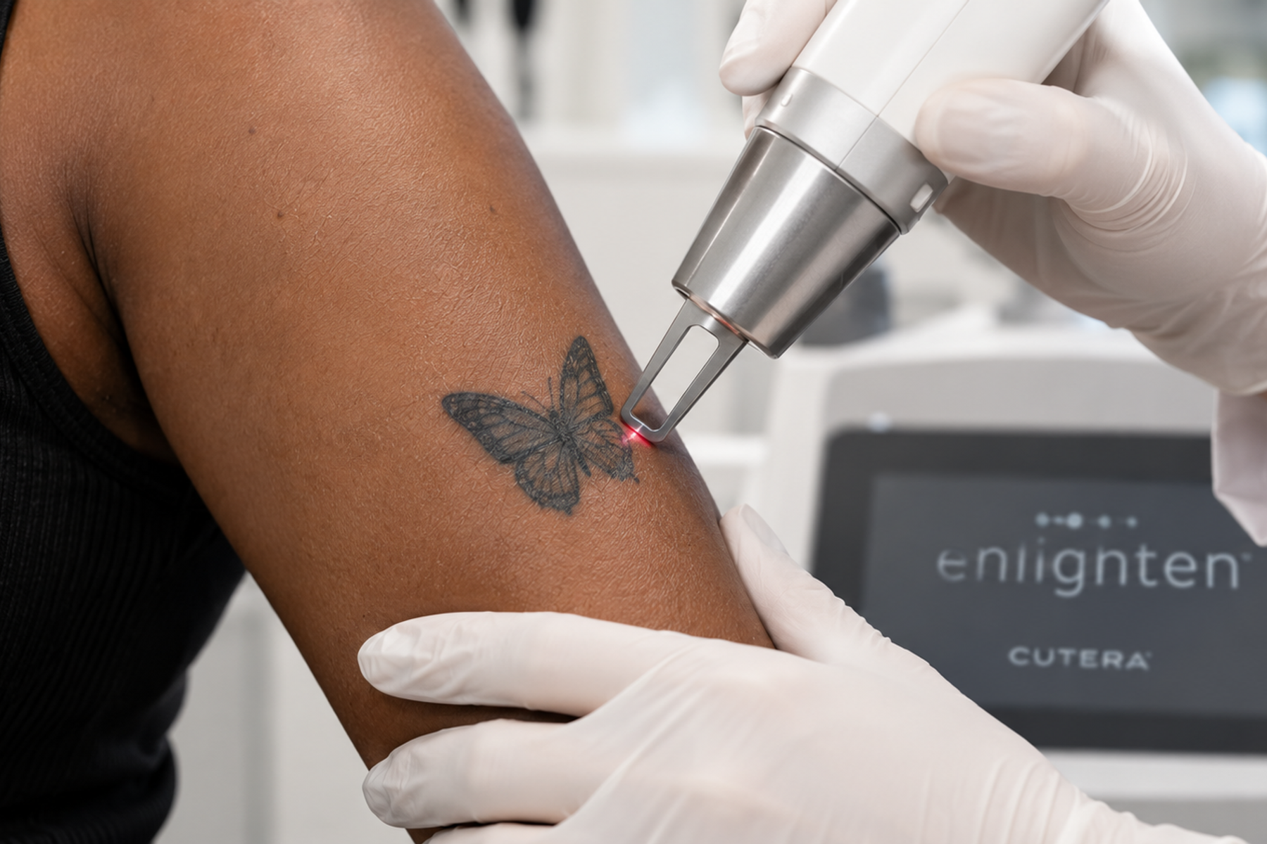 Close-up of a laser handpiece positioned over a black tattoo on a person with darker skin.