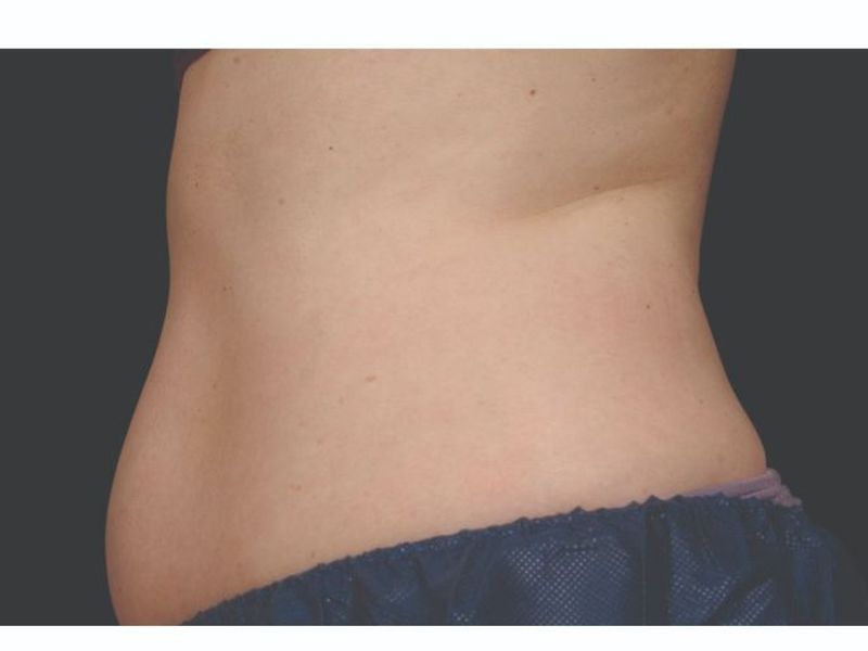 Abdomen and waist Before CoolSculpting Body Contouring fat loss Treatment in Montreal