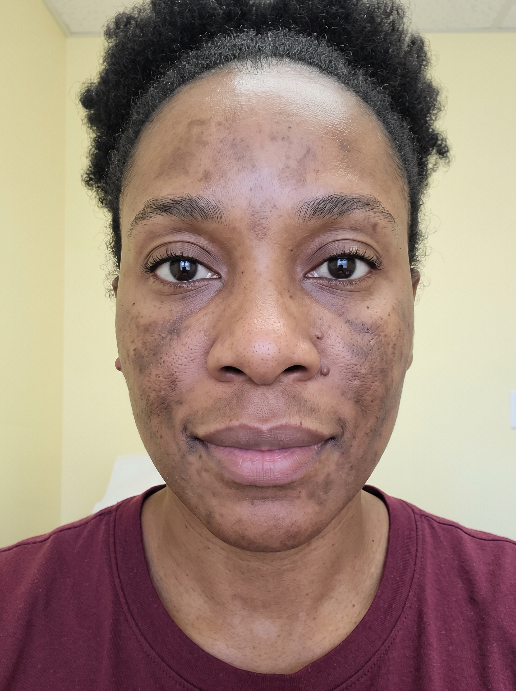 Patient photographed before treatment, facing the camera under even, directional daylight.