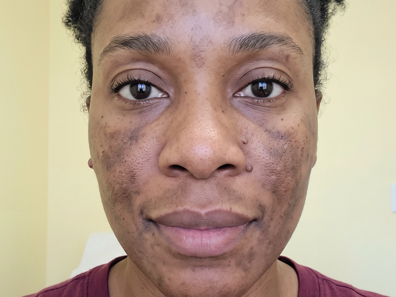 Patient photographed before treatment, facing the camera under even, directional daylight.