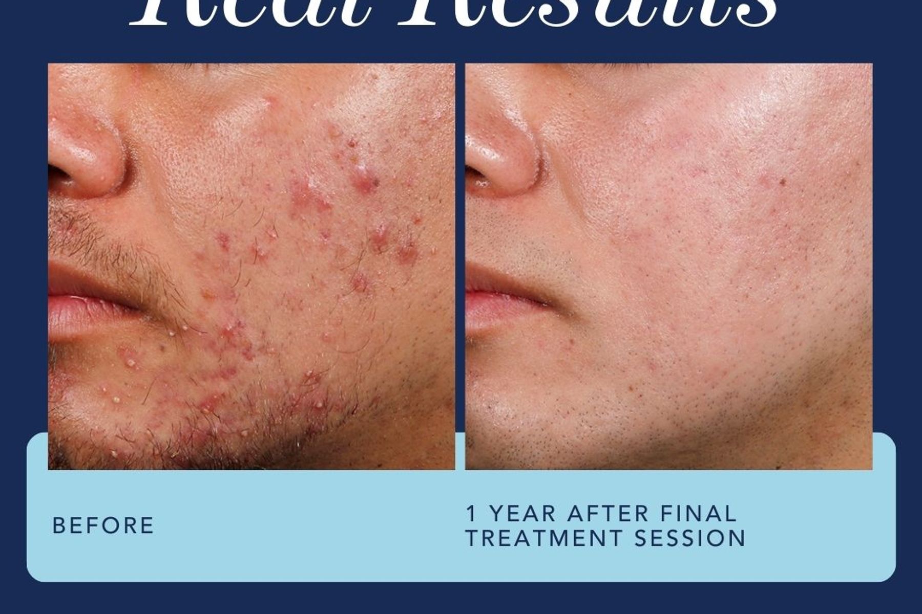 Clear Skin Ahead: Exploring Effective Acne Treatments/