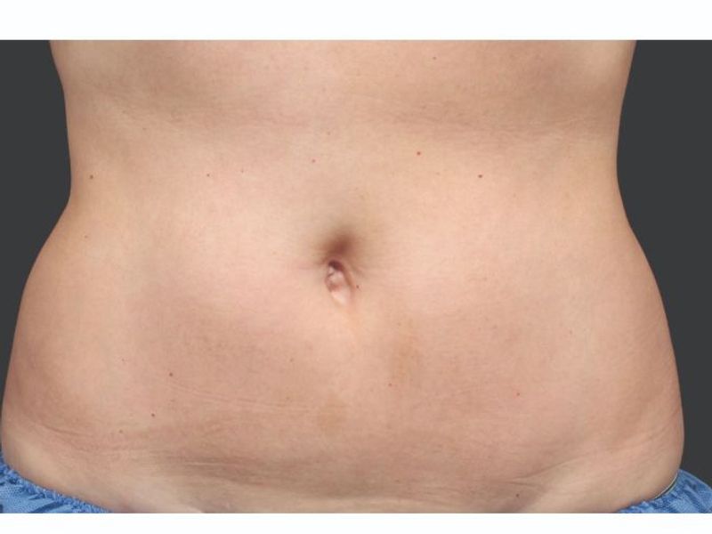 Belly fat after CoolSculpting Body Contouring fat loss Treatment in Montreal