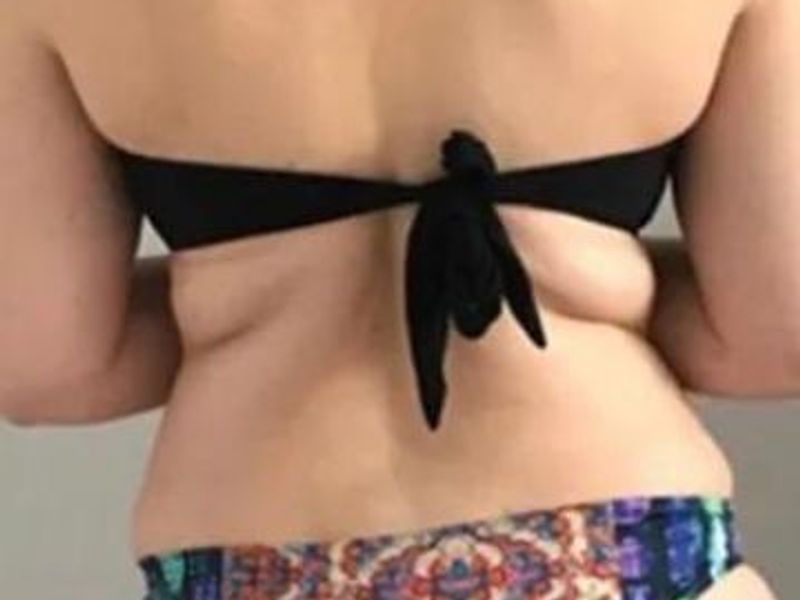 Muffin tops before Slimwave Montreal treatment at Ideal Body Clinic