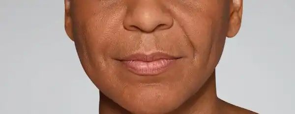 Before Aesthetic Hyaluronic acid dermal fillers injectables in Montreal