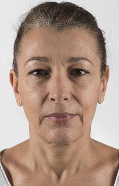 Before Aesthetic Hyaluronic acid dermal fillers injectables in Montreal