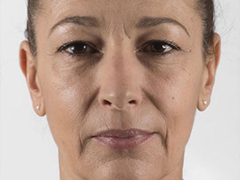 Before Aesthetic Hyaluronic acid dermal fillers injectables in Montreal