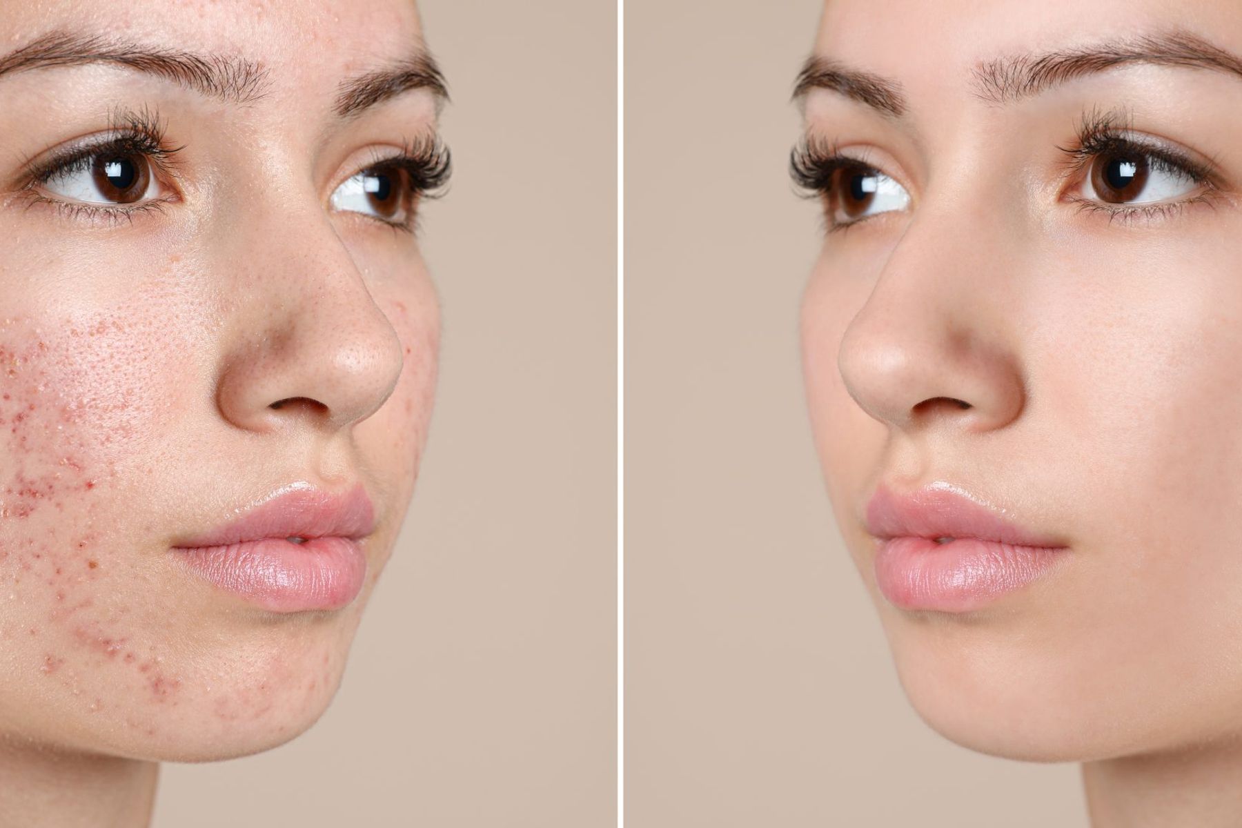 Advanced Acne Treatments: AviClear & Fotona Laser for Clear, Healthy Skin