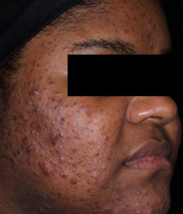Before AviClear laser acne removal treatment, Ideal Body Clinic, Montreal