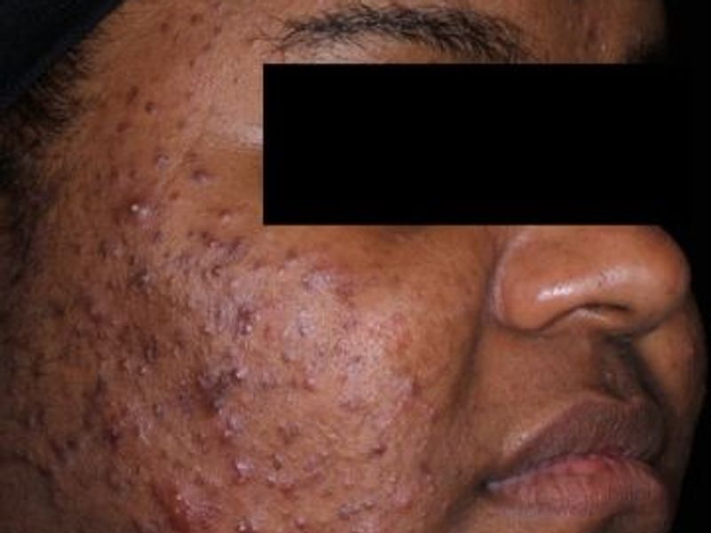 Before AviClear laser acne removal treatment, Ideal Body Clinic, Montreal