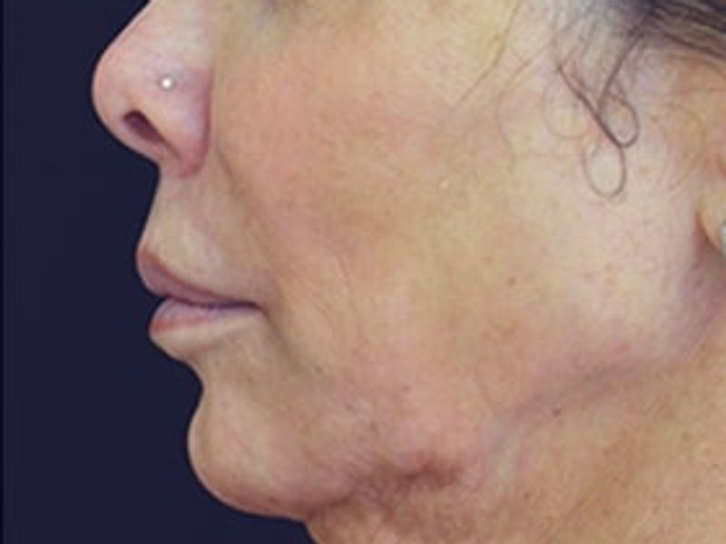 Patient before chin Scarlet-S RF treatment - Ideal Body Clinic Montreal