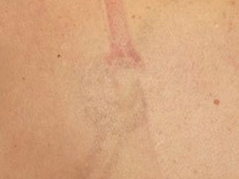Before Fotona Laser Skin tattoo removal - Montreal